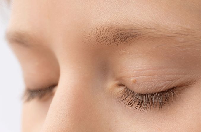 How To Remove Skin Tags Around Eyes