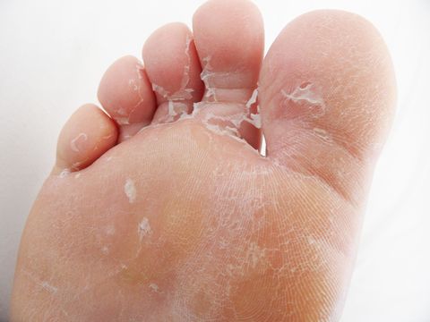 How To Get Dead Skin Off Your Feet?