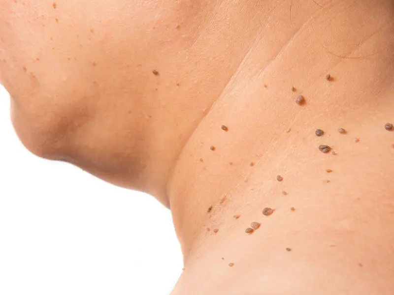 How Much Does It Cost To Remove Skin Tags